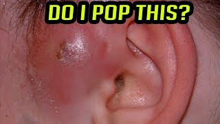 Abscesses Furuncles amp Infections  Do NOT Pop These [upl. by Mckinney]