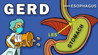 Gastroesophageal Reflux Disease GERD [upl. by Lay]