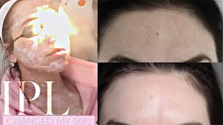 IPL The Facial that changed my skin [upl. by Neall636]