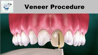 Dental Veneers Procedure Step by step [upl. by Elisabeth973]