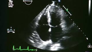 Atrial Fibrillation On Echocardiogram [upl. by Arbe]