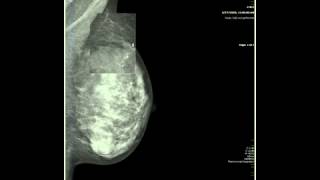 Breast Imaging Calcifications  module 2  Health4TheWorld Academy [upl. by Akerley94]