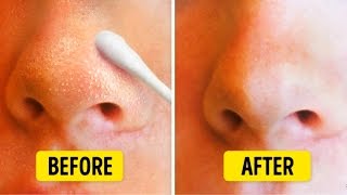 9 Natural Ways to Get Rid of Blackheads on Nose [upl. by Romalda]