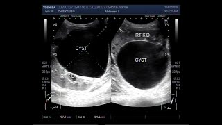 What does a kidney cyst look like on MRI [upl. by Adnohsar]