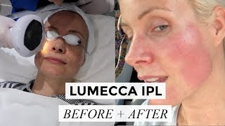 LUMECCA IPL  BEFORE  AFTER  Liv Judd [upl. by Aicilec984]