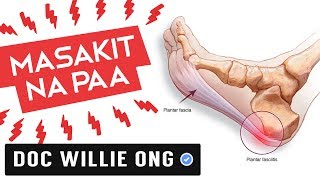 MASAKIT na PAA Plantar Fasciitis  ni Doc Willie at Liza Ong 377b [upl. by Carrelli]