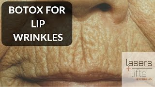 BOTOX for lip wrinkles [upl. by Nlocnil]