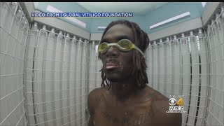 Doctor Says Vitiligo Can Be Treated [upl. by Lishe300]