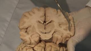 Cortical Localization Neuroanatomy Video Lab  Brain Dissections [upl. by Ydospahr]