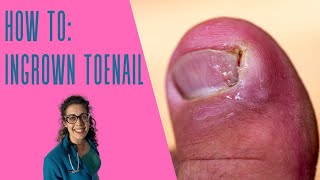 How to treat an ingrown toenail and removal [upl. by Shane38]