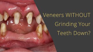 Dental Veneers Without Grinding Your Teeth Away [upl. by Kegan]