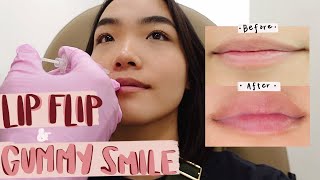 getting my lips done  lip flip  gummy smile transformation [upl. by Aremus]