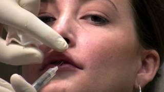 Juvederm Ultra filler injection to lips for lip augmentation in Virginia [upl. by Ylrrad]