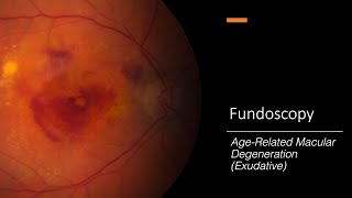 Inclusion Body Myositis IBM Disease Overview  Johns Hopkins Myositis Center [upl. by Meit]