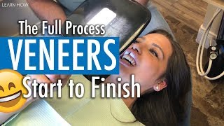 How Do Veneers Work  MY WIFES FULL PROCEDURE [upl. by Forsyth207]