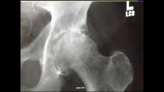 Direct Anterior Approach Hip Replacement [upl. by Felisha]