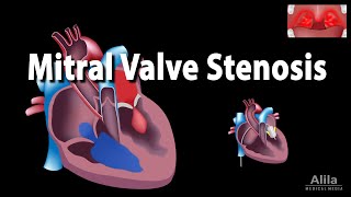 Mitral Valve Stenosis Animation [upl. by Nangem267]