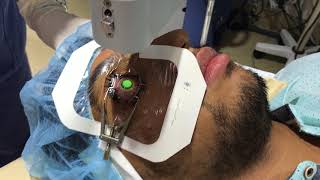 Collagen Cross Linking For keratoconus [upl. by Cesare]