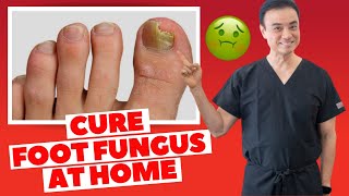 6 Effective HOME REMEDIES To CURE Toenail FUNGUS  Holistic Toenail Fungus Cures Part 2  Dr Kim [upl. by Priscella]