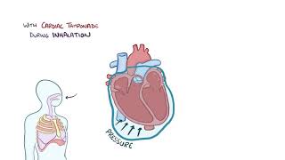 Cardiac tamponade causes symptoms diagnosis treatment pathology [upl. by Barnaby233]