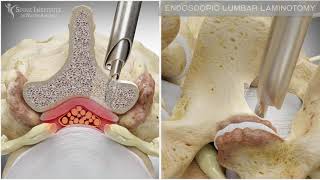 Endoscopic Lumbar Laminotomy  Spine Institute of North America [upl. by Lezned]