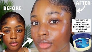 HOW VASELINE HELPED CLEAR MY ACNE AND EZCEMA FASTER  KAISERCOBY [upl. by Niveek]