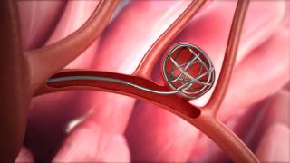 Prostate Artery Embolization PAE Explained [upl. by Abe]