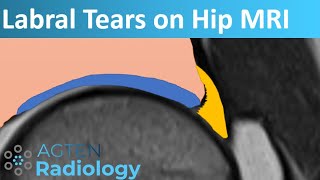 Labral Tears on Hip MRI [upl. by Eizdnil]