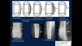 Bone Lesions Radiographic Assessment Part 1 by Geoffrey Riley MD [upl. by Kaiser]