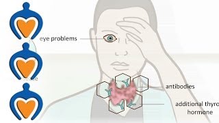 Schildklierproblemen  over de symptomen van hyperthyreoïdie hypothyreoïdie en struma [upl. by Yssis]