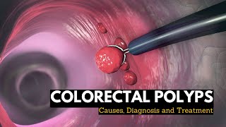 Colorectal Polyps Causes Signs and Symptoms Diagnosis and Treatment [upl. by Nnylireg231]