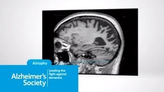 What is posterior cortical atrophy [upl. by Molohs]