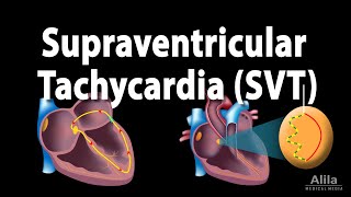 Supraventricular Tachycardia SVT PSVT Animation [upl. by Leilah]