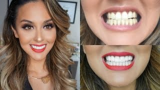 My Teeth Transformation l Veneers Experience [upl. by Vladamar227]