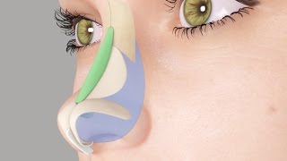 Saddle Nose or Ski Slope Nose Rhinoplasty Nosejob [upl. by Tallula651]