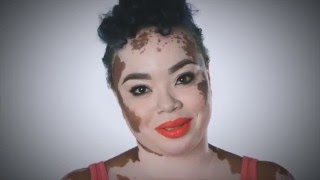 Vitiligo Truth Hope and Change fulllength [upl. by Jobi]