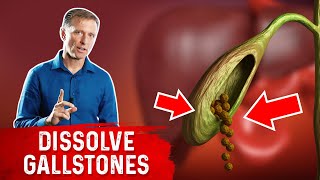 Do This to Help Dissolve Gallstones [upl. by Hars]