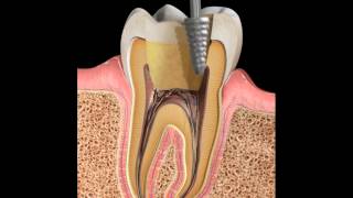 Endodoncia Tratamiento de conducto [upl. by Selda]