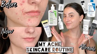 How I Cleared My HORMONAL ACNE amp SCARRING with Affordable Skincare  Dry amp Sensitive Skin [upl. by Wake]