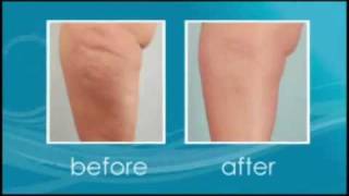 Cellulaze Cellulite Treatment Florida [upl. by Esir27]