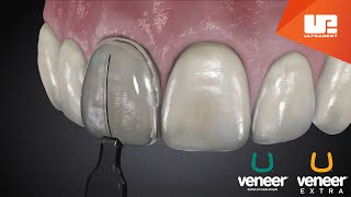 Uveneer® Procedure Animation  Direct Veneer Template System [upl. by Hgierb811]