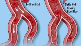 Management of acute severe ulcerative colitis [upl. by Kcirret]