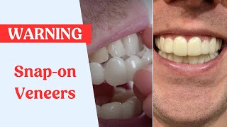 Snap On Veneers Warning [upl. by Fenny]