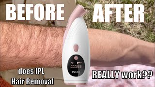 Intense Pulse Light IPL Therapy Helps Remove Dark Spots Wrinkles and More [upl. by Longawa916]