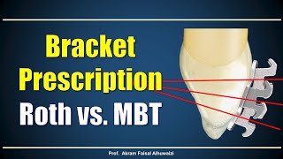 Using Roth and MBT brackets [upl. by Bertsche]