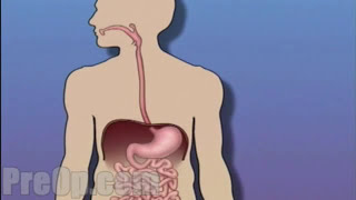 Esophagogastroduodenoscopy [upl. by Ibmab]