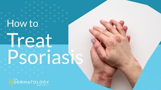 Psoriasis Treatment  Explained by Dermatologist [upl. by Adelina]