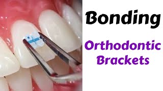 Step by Step Orthodontic Brackets Bonding Technique MBT  orthodontic lecture [upl. by Cletis]