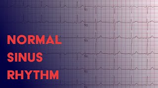 Normal Sinus Rhythm  EKG ECG Interpretation [upl. by Horgan]