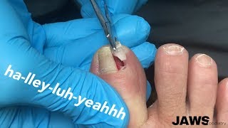 REMOVING A LARGE INGROWN TOENAIL [upl. by Nylorahs]